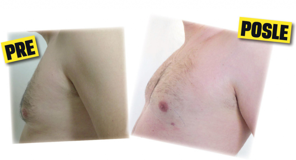 Seku grudi, „lepe“ bradavice