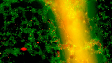 Nanočestice uništavaju ćelije raka