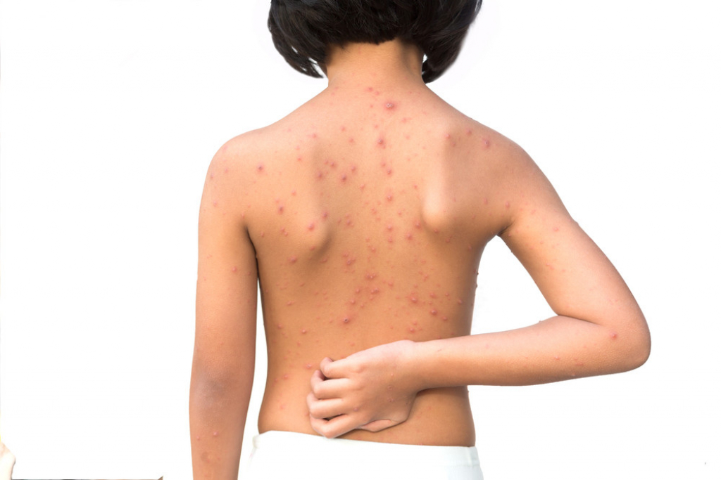 Boginje svrab češanje alergija bubuljice morbili male boginje