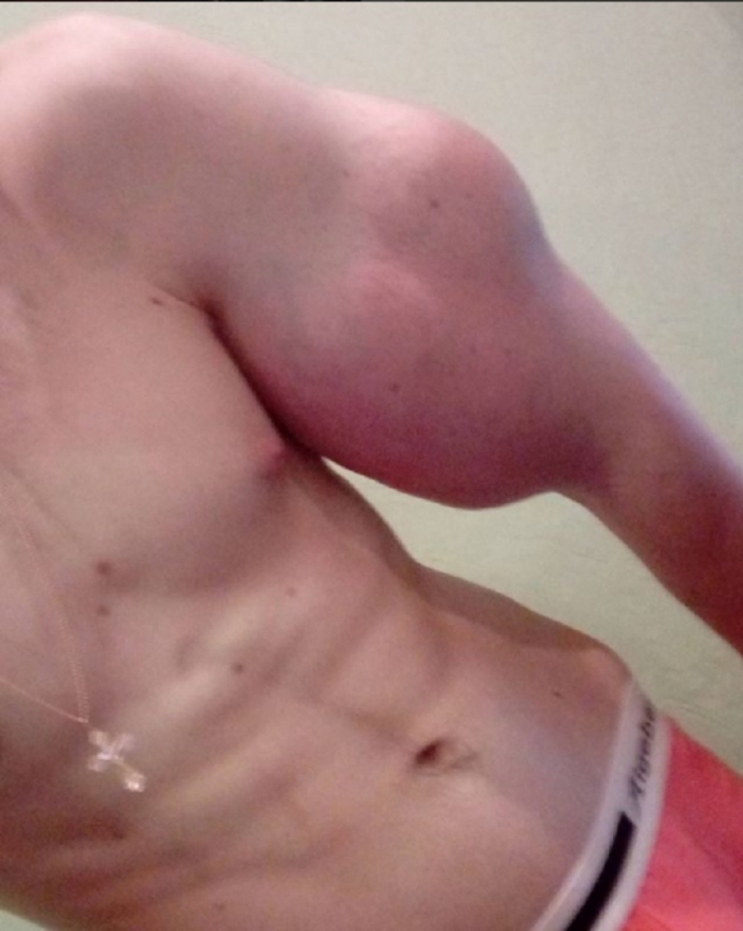 Ubrizgava hemiju u ruke da bi imao veći biceps