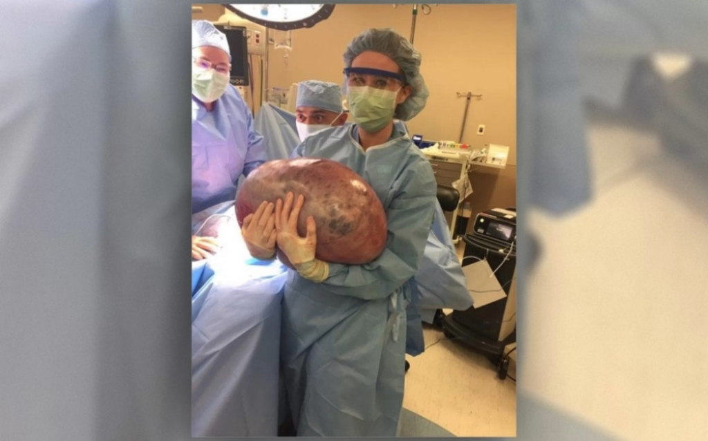 Iz žene izvadili tumor od 23 kilograma