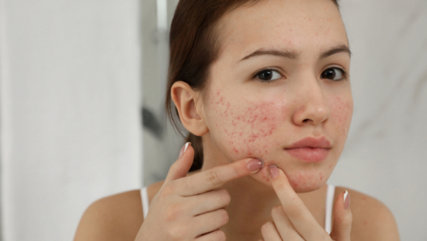 Koža će vam biti zahvalna: Ukoliko imate problem sa aknama, koristite ovo