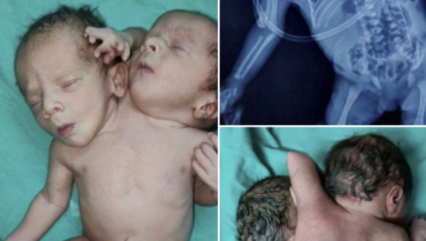 UZNEMIRUJUĆI SADRŽAJ! Rođena beba sa dve glave, dva srca i tri ruke (FOTO/VIDEO)