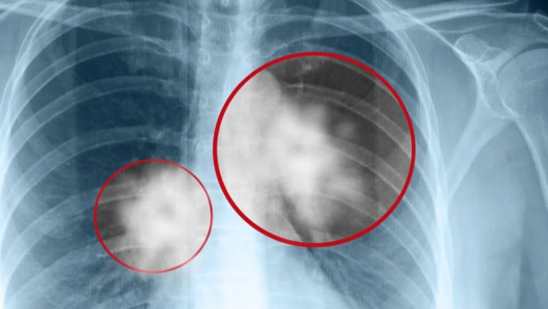 NE IGNORIŠITE OVU PROMENU NA TELU: Lekari kažu da je najraniji znak raka pluća