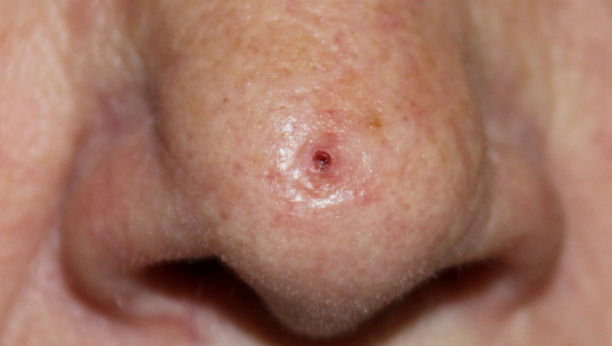 tumor na nosu