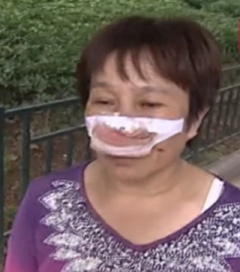 Kina: Muž ženi odsekao nos i pojeo ga