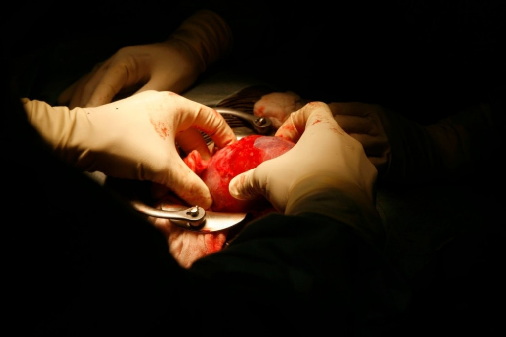 Bubreg, operacija, transplatacija