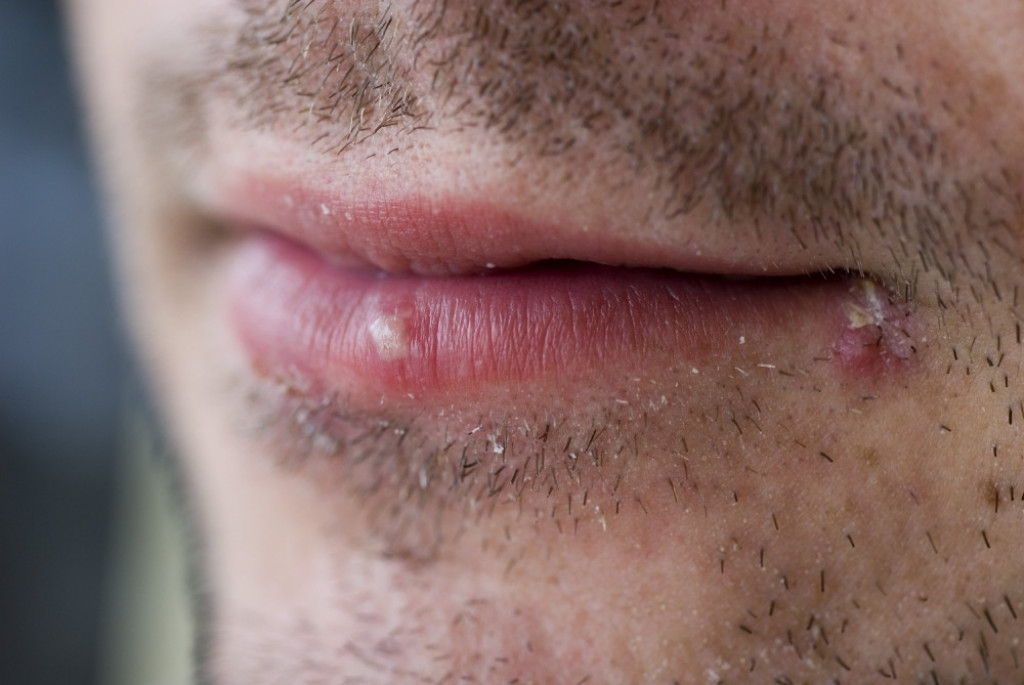 Herpes Groznica na usnama Neobrijan muškarac momak