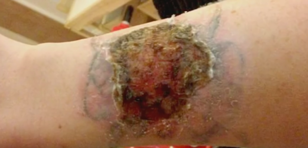 Rane posle uklanjanja tetovaže