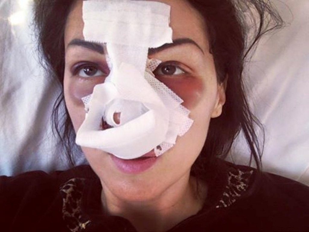 Nela Vidaković nakon operacije nosa