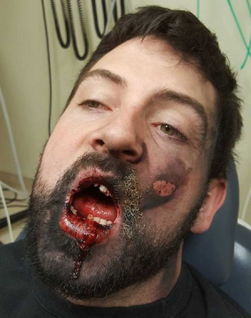 Eksplodirala elektronska cigareta