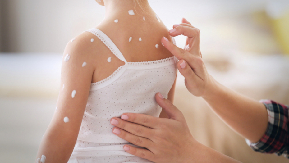 Boginje svrab češanje alergija bubuljice morbili male boginje