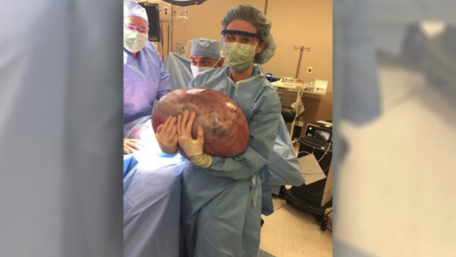 Iz žene izvadili tumor od 23 kilograma