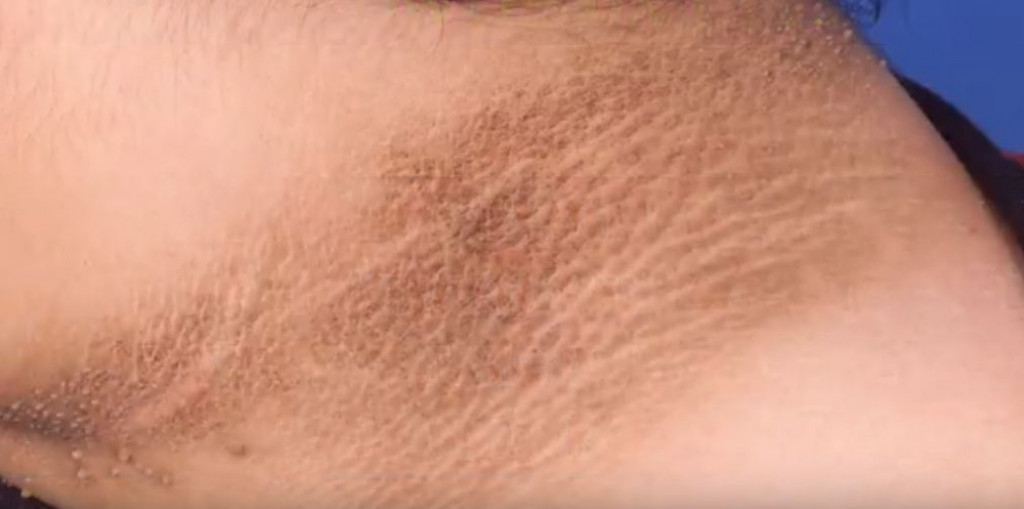 Acanthosis nigricans