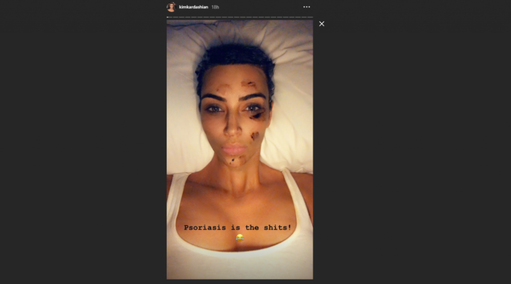 Kim Karda&scaron;ijan, psorijaza