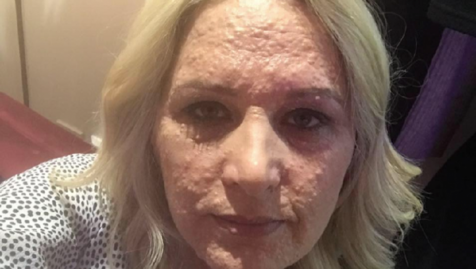 Rejčel, tumori na koži