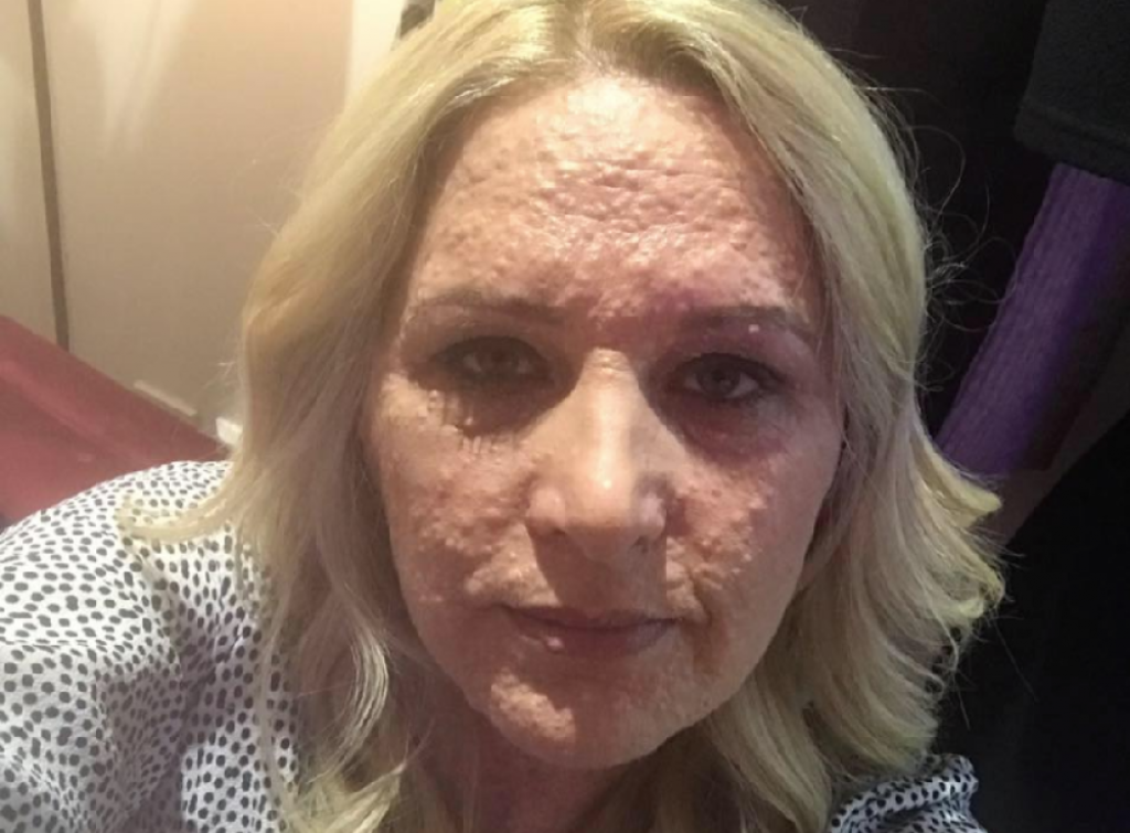 Rejčel, tumori na koži