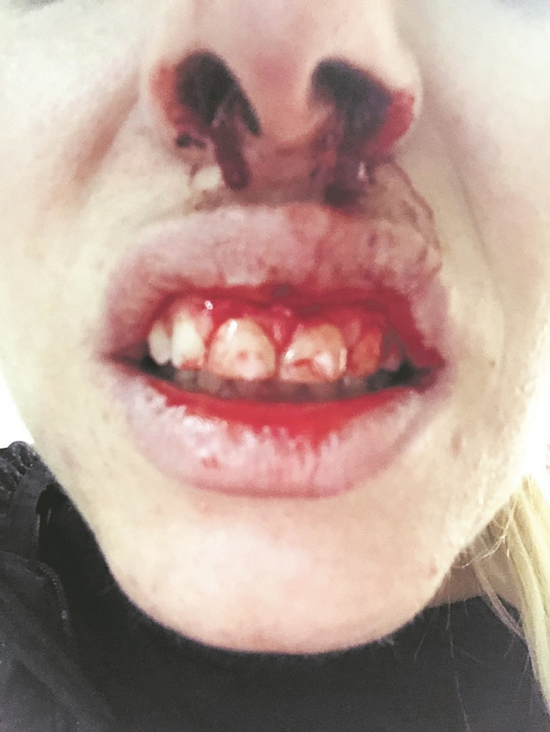 Nasilnica razbila zube i nos Mariji Milenković