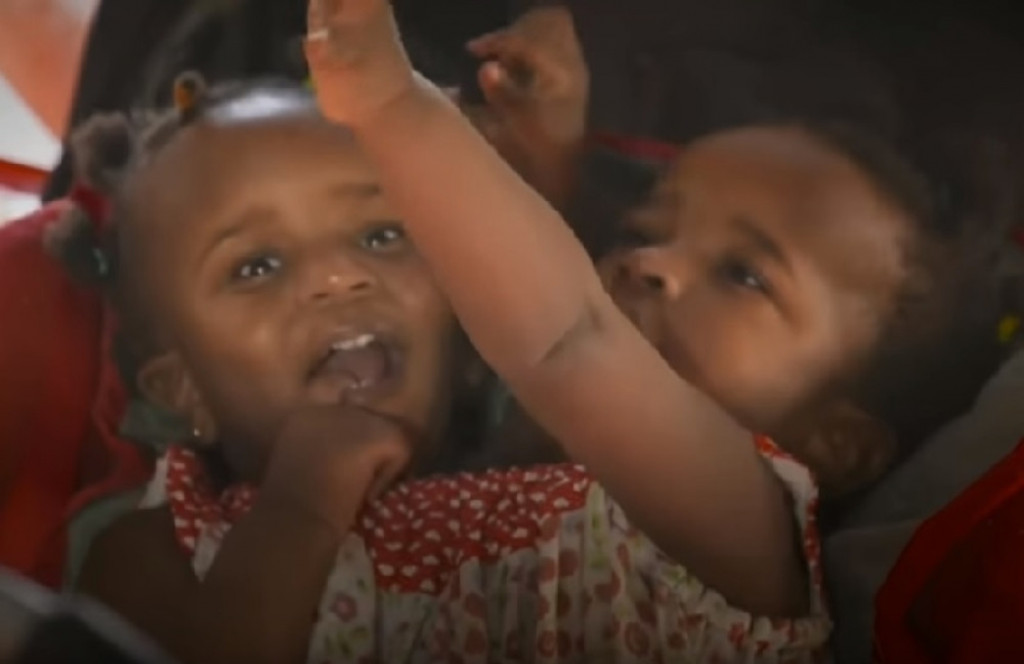 Sijamske bliznakinje