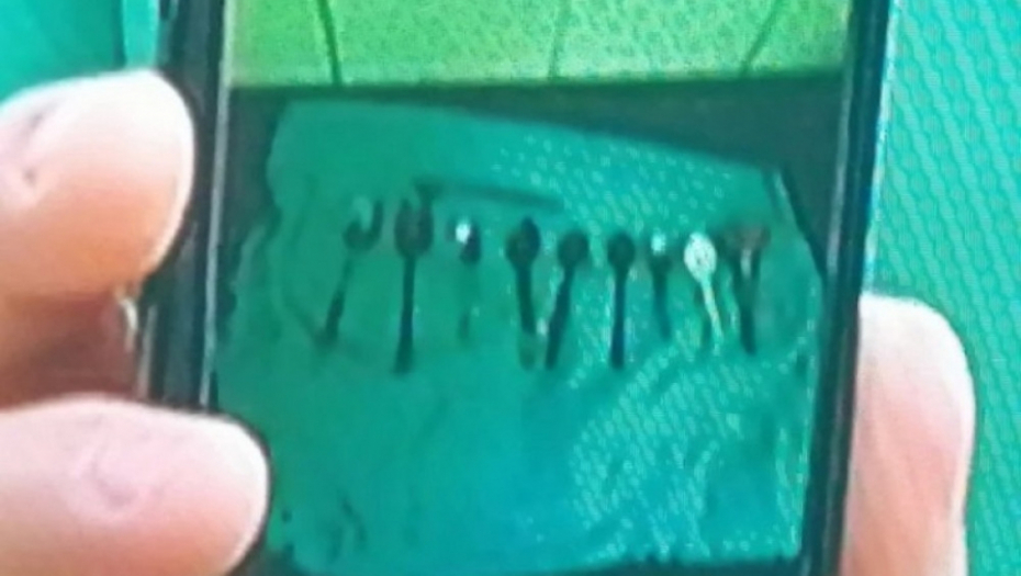 Pacijentu nađeno 9 kašika u stomaku