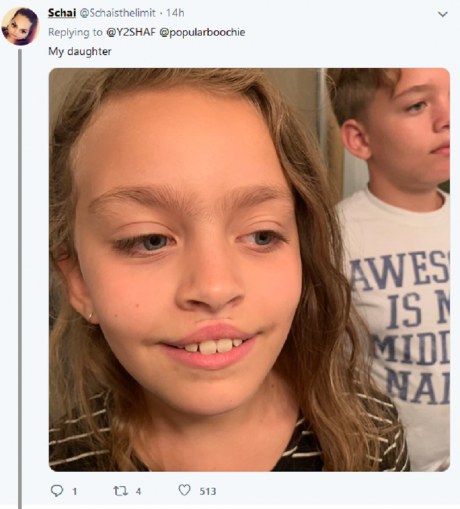 povećanje usana lepkom, dete, 