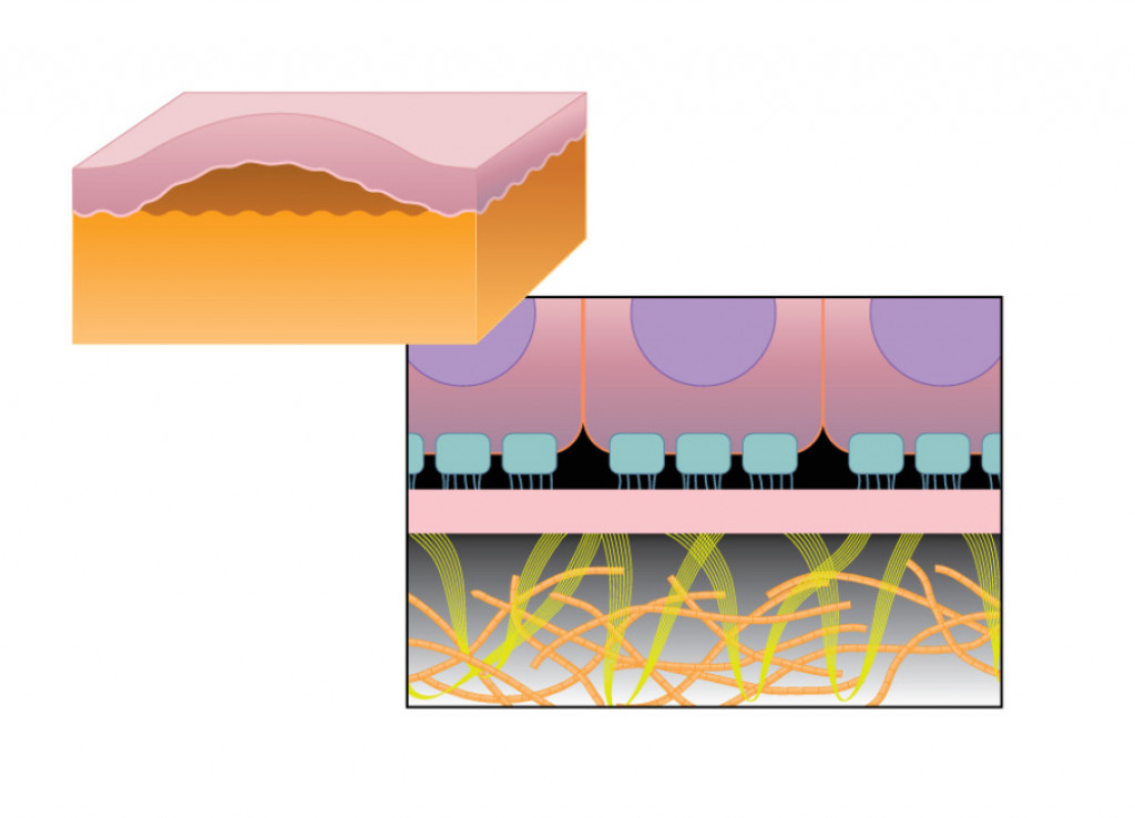 bulozna epidermoliza