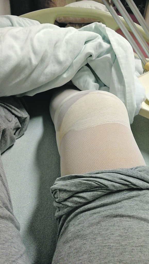 Nata&scaron;ino koleno nakon intervencije