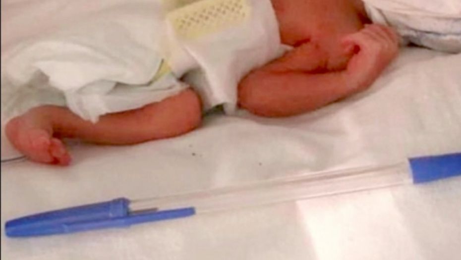 Beba rođena u veličini olovke