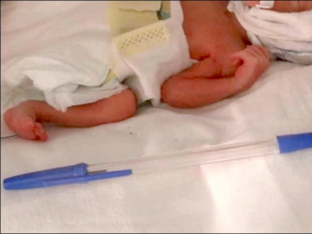 Beba rođena u veličini olovke