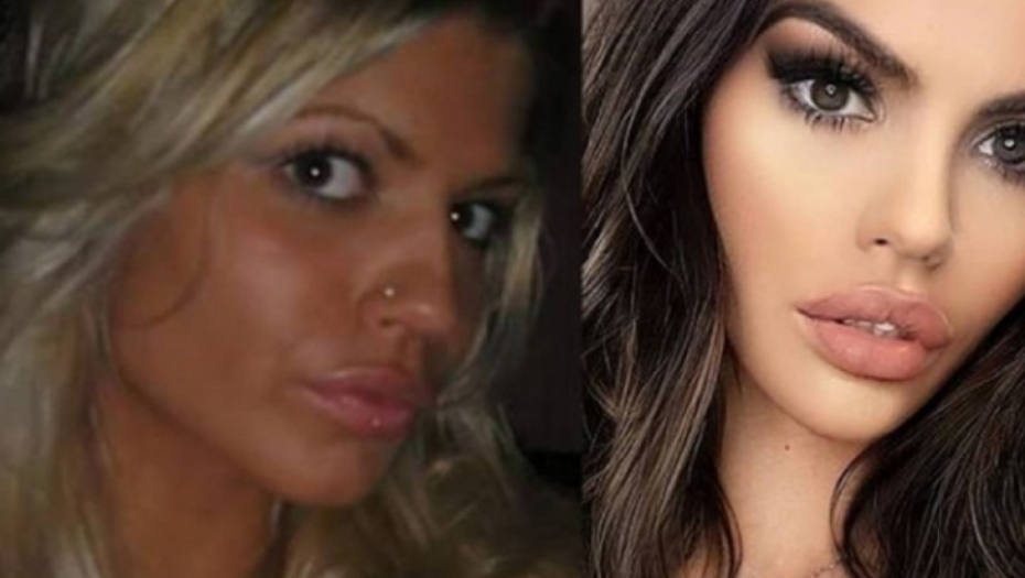 Poznati PRE I POSLE operacija