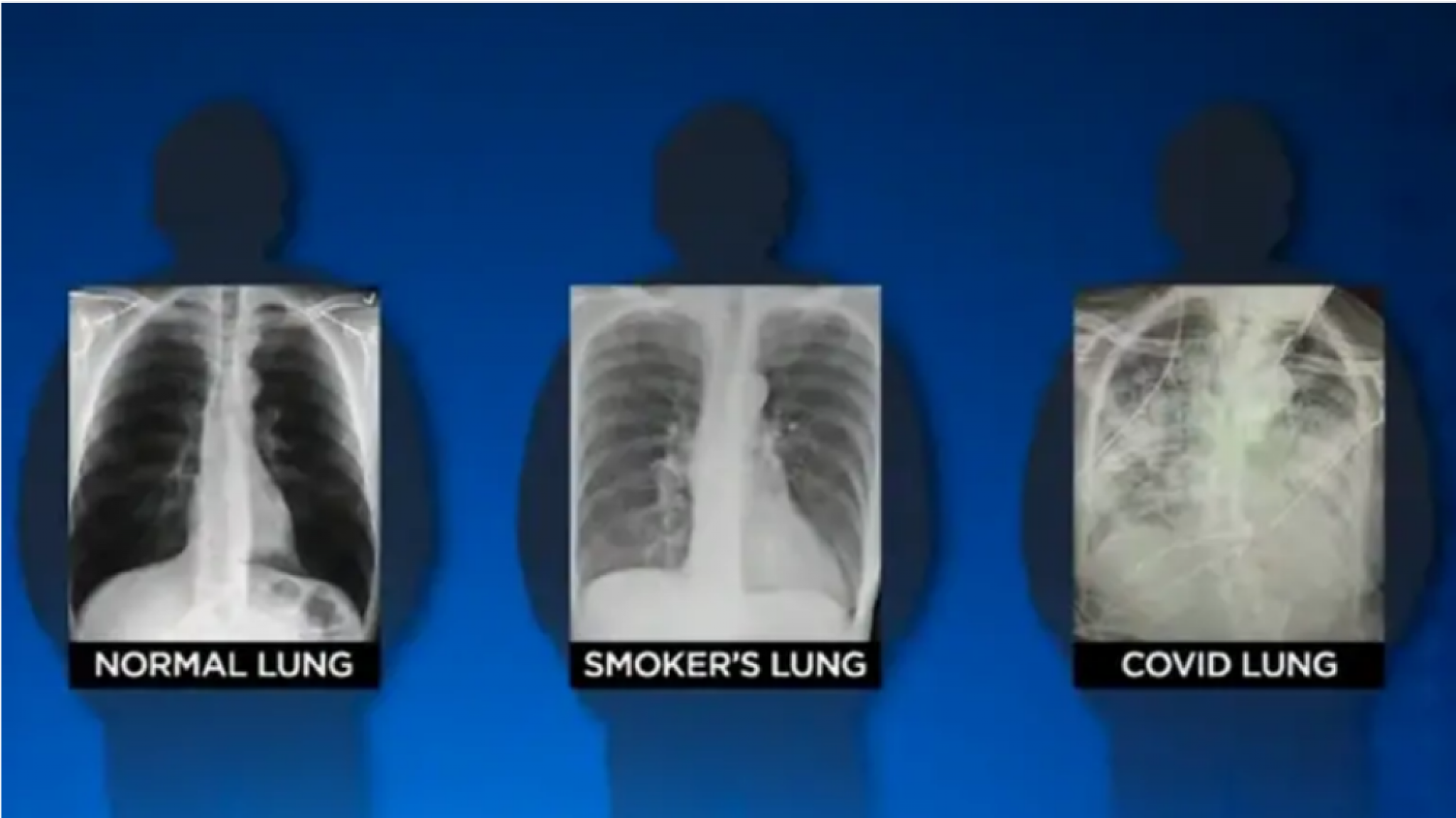 Zdrava pluća, pluća dugogodišnjeg pušača i kovid pluća