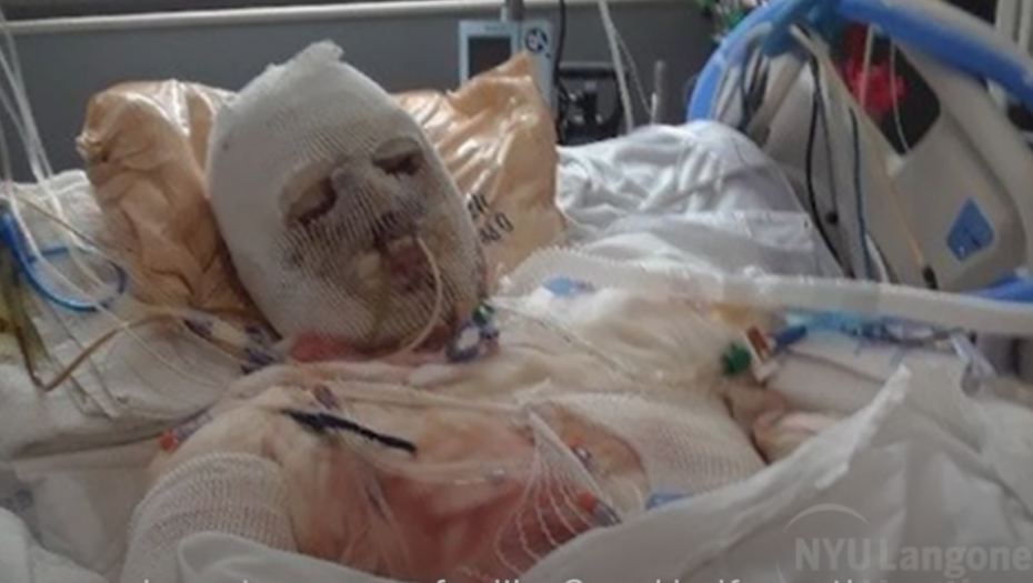 operacija, transplatacija