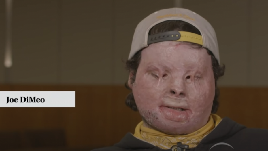 operacija, transplatacija