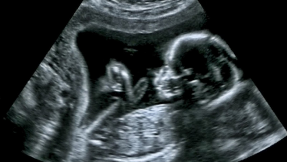 beba, ultrazvuk