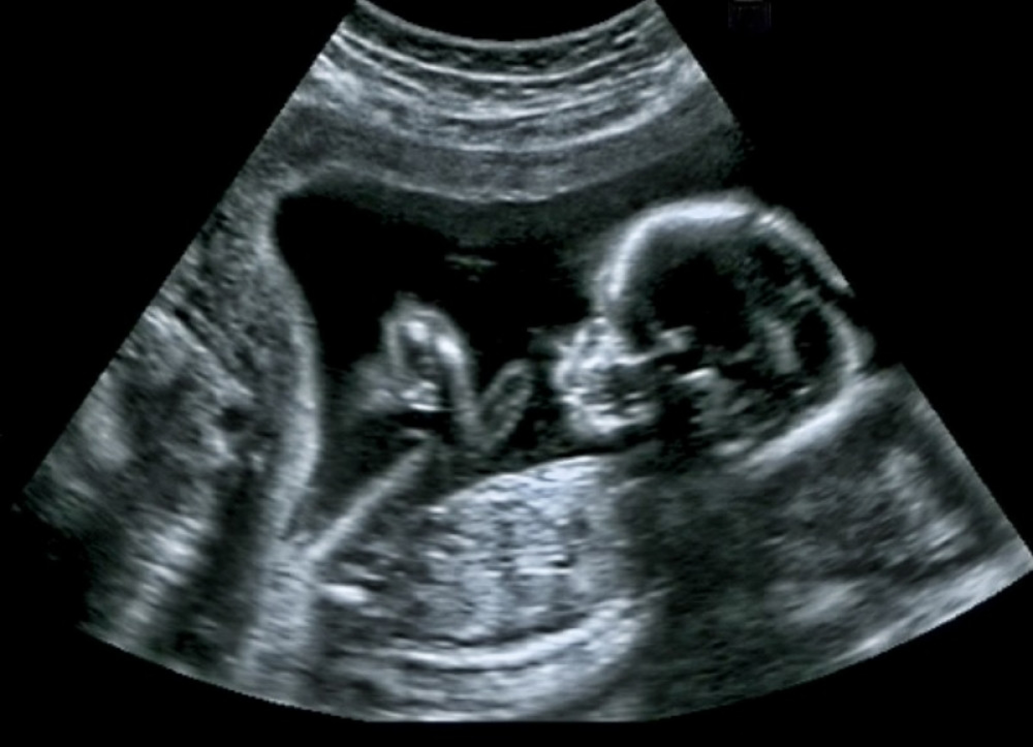 beba, ultrazvuk