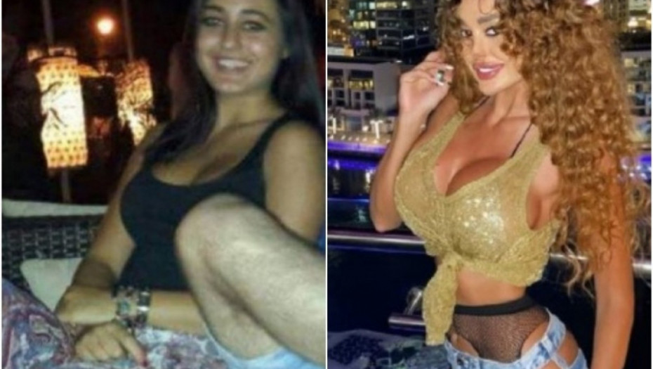 ALO! OTKRIVA! Starleta spiskala bogatstvo da bi izgledala kao lutka, Ana iskeširala 7.000 evra za vađenje rebara! (PRE I POSLE FOTO)