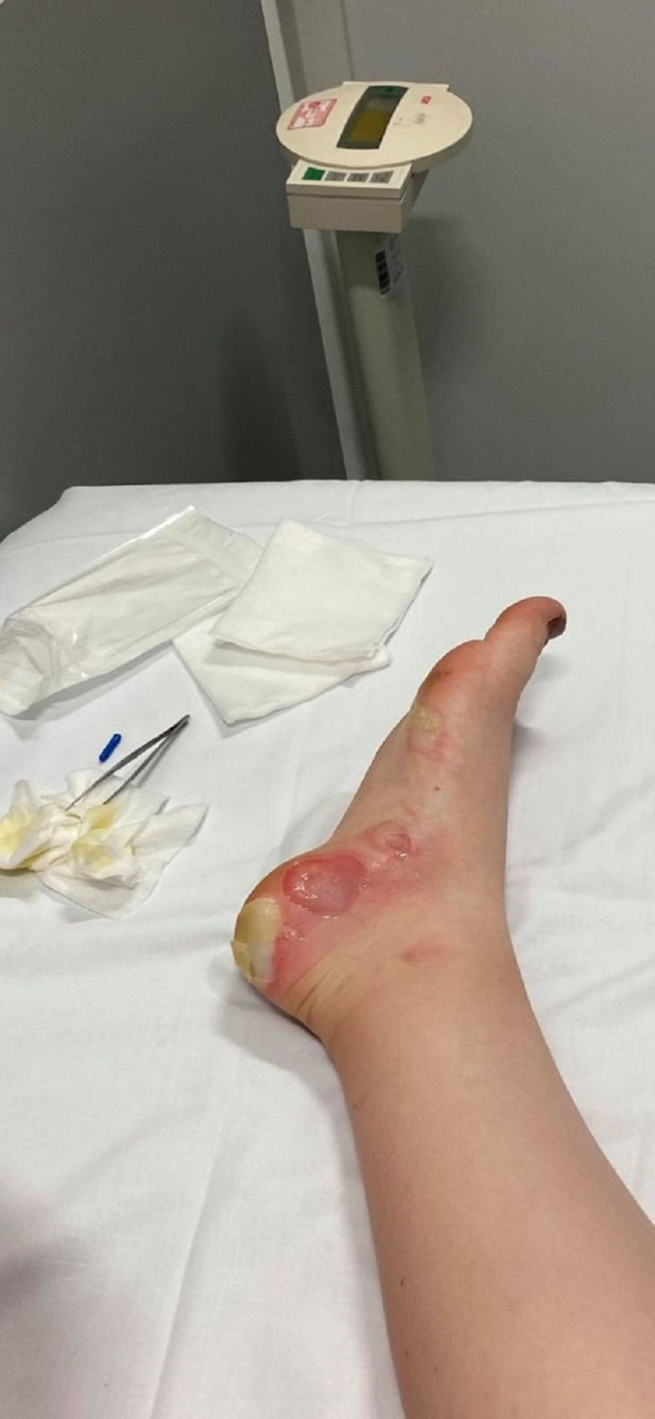 opekotine, transplatacija