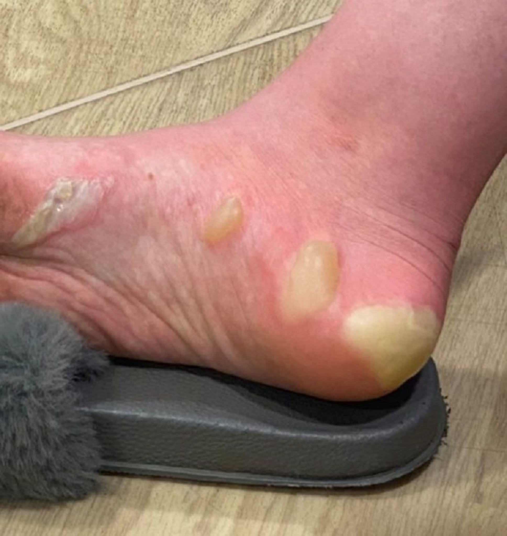 opekotine, transplatacija