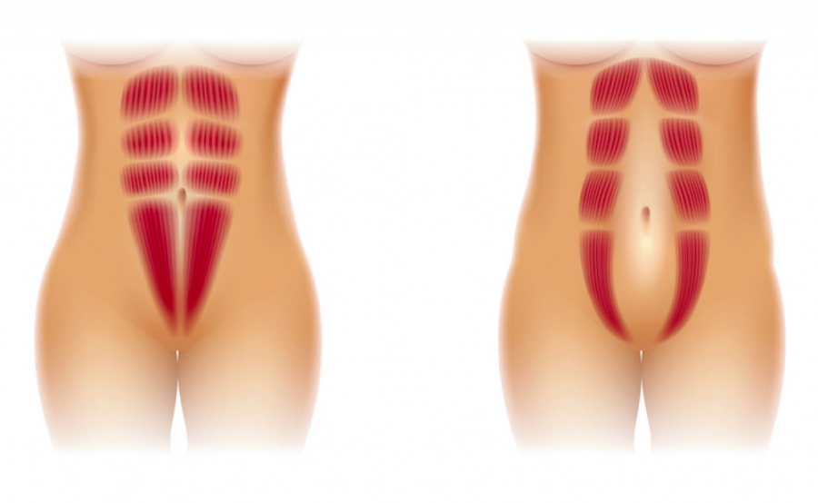 DIJASTAZA JESTE IZLEČIVA Svaka treća trudnica pati od razdvajanja trbušnih mišića nakon porođaja, ali rešenje postoji