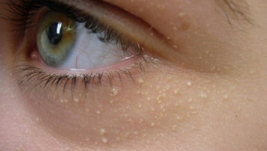 Ako primetite ovu promenu na koži, hitno se javite lekaru! U pitanju je srce!