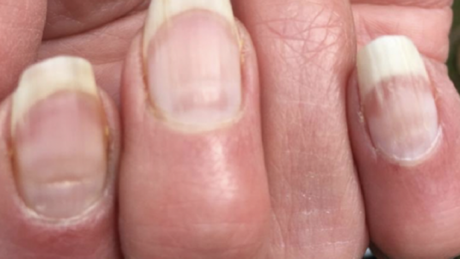 Nokti, bolest, hrapavi nokti