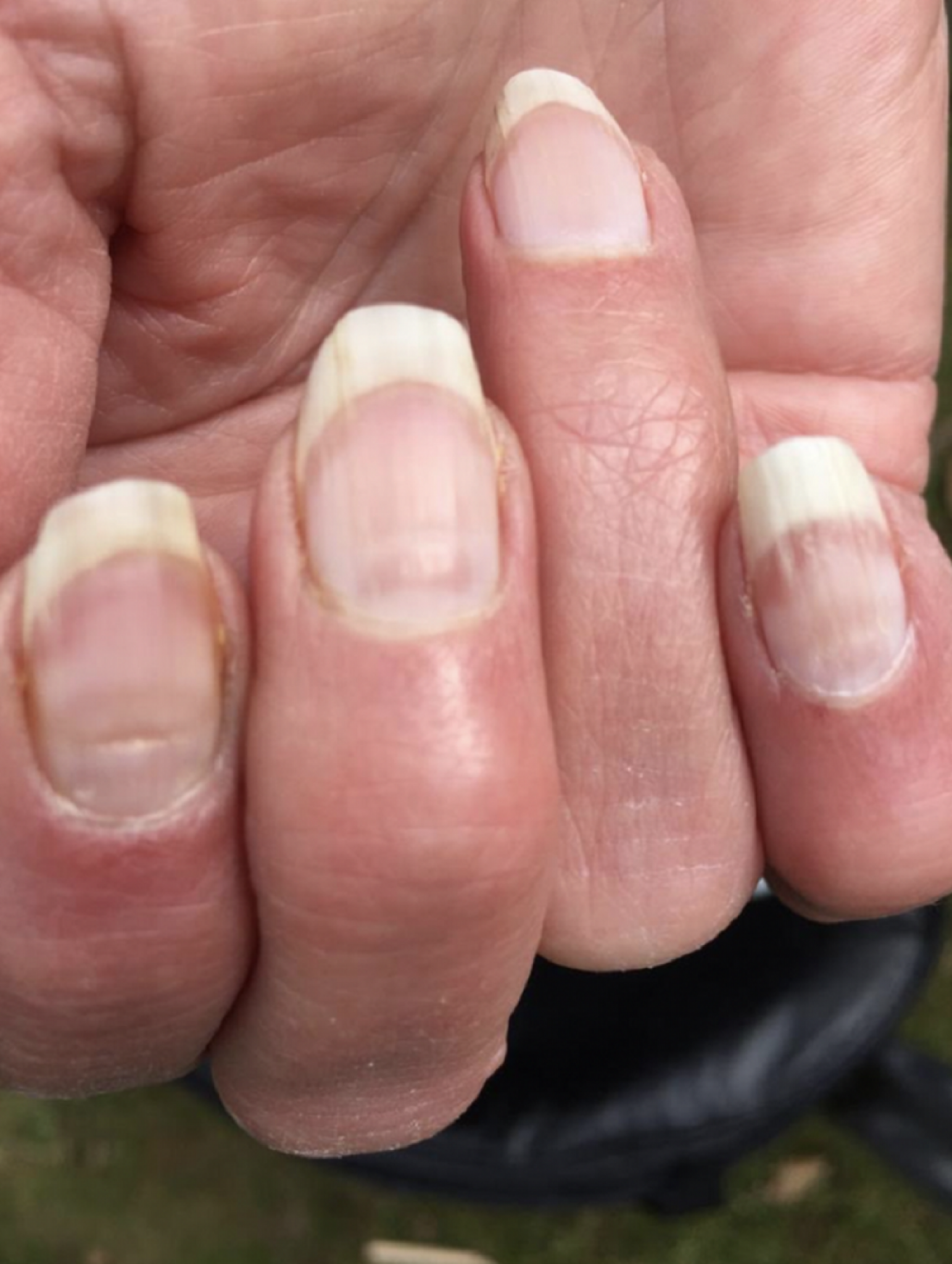 Nokti, bolest, hrapavi nokti