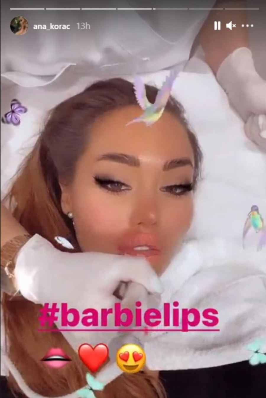 DOKLE BRE VIŠE?! Ana Korać ponovo išla na estetski zahvat, sada izgleda bukvalno kao barbika! (FOTO)