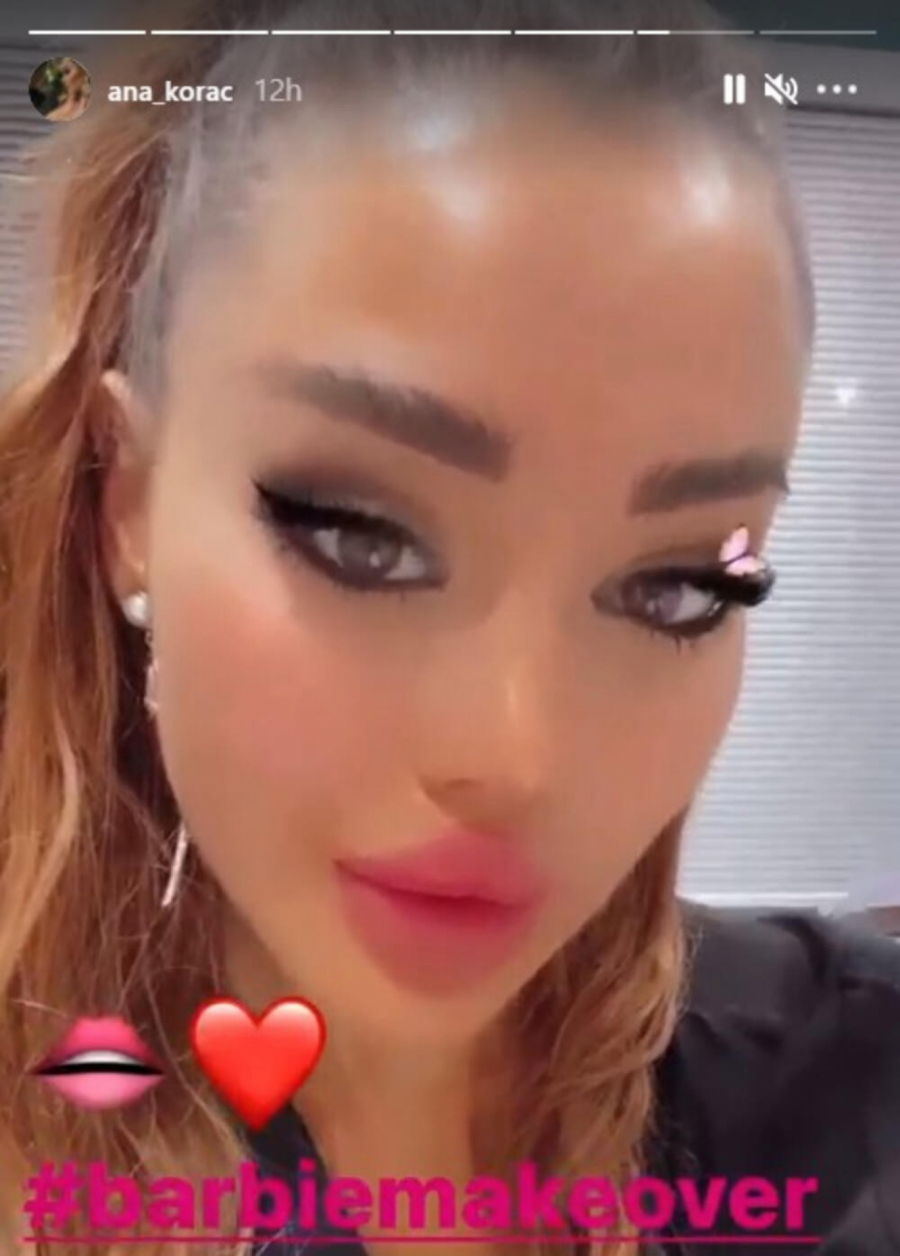 DOKLE BRE VIŠE?! Ana Korać ponovo išla na estetski zahvat, sada izgleda bukvalno kao barbika! (FOTO)