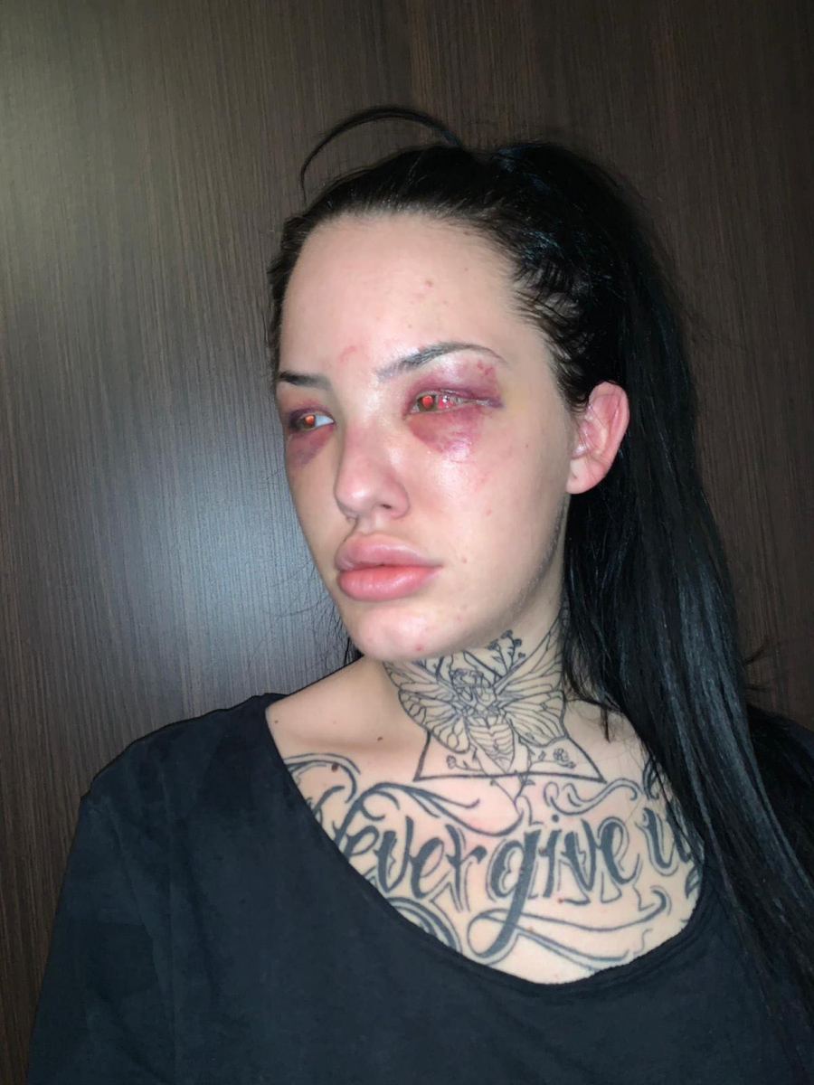 PREBIJENA NA MRTVO IME Ovako izgleda drugarica Tijane Ajfon nakon što ju je dečko pretukao, nije za one slabog srca!