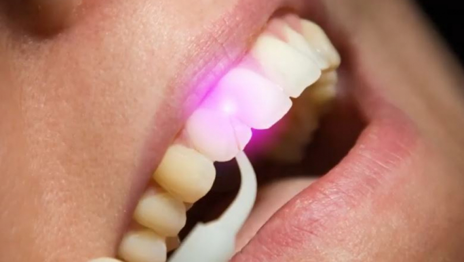 SAMO 8,5 ODSTO GRAĐANA SRBIJE IMA SVE ZUBE, POKAZALO JE ISTRAŽIVANJE INSTITUTA "BATUT" Srbi ne idu zubaru jer štede