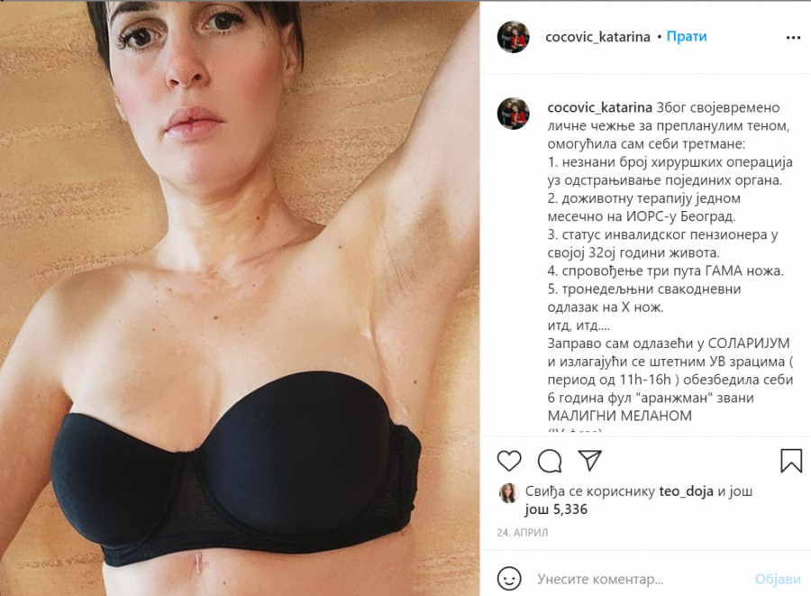 ZBOG SOLARIJUMA DOBILA RAK KOŽE Katarina je želela da ima taman ten, a onda se teško razbolela, jedan za drugim su joj odstranjivani organi
