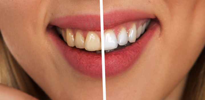 STOMATOLOZI UPOZORAVAJU: Ovo je razlog zašto vam zubi žute