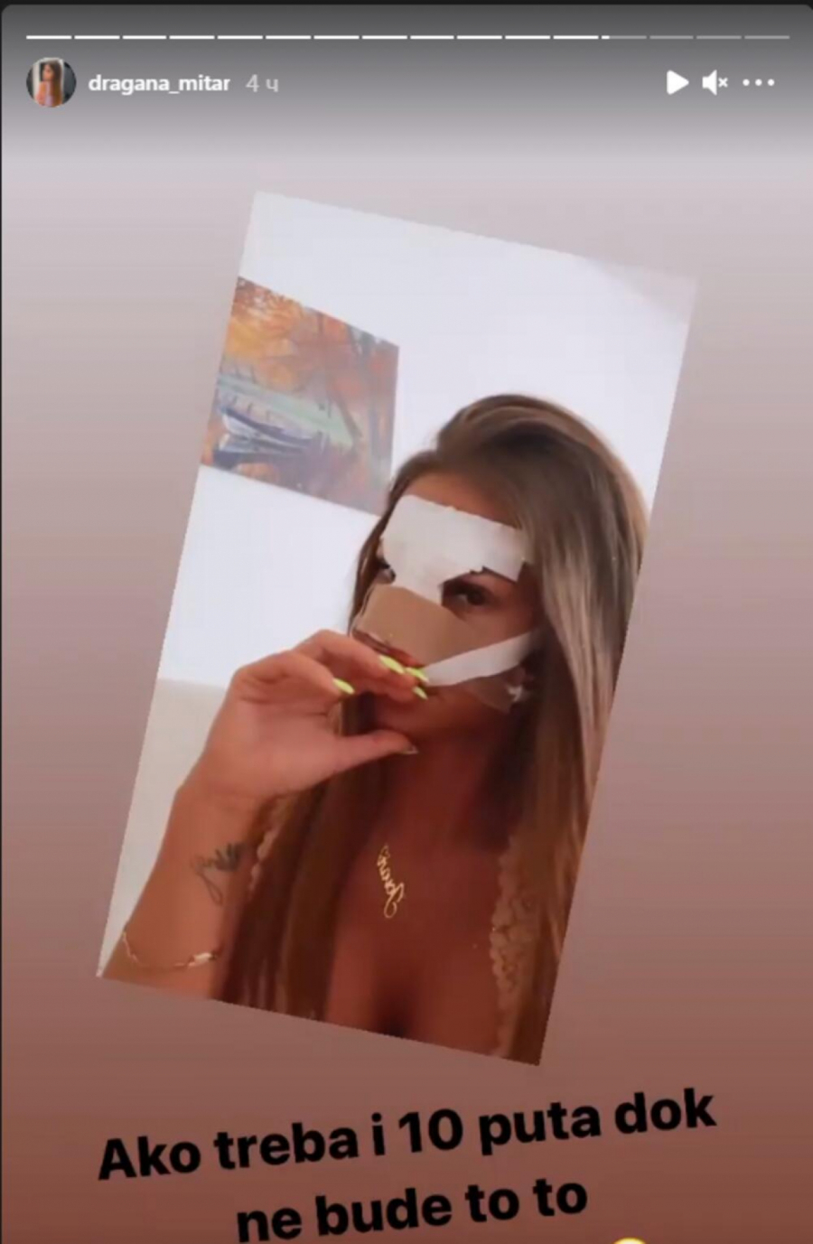 ZA POLA GODINE PUKLA 6.000 EVRA NA PLASTIČNE OPERACIJE! Dragana Mitar ponovo otišla pod nož i opet nije zadovoljna izgledom (FOTO)