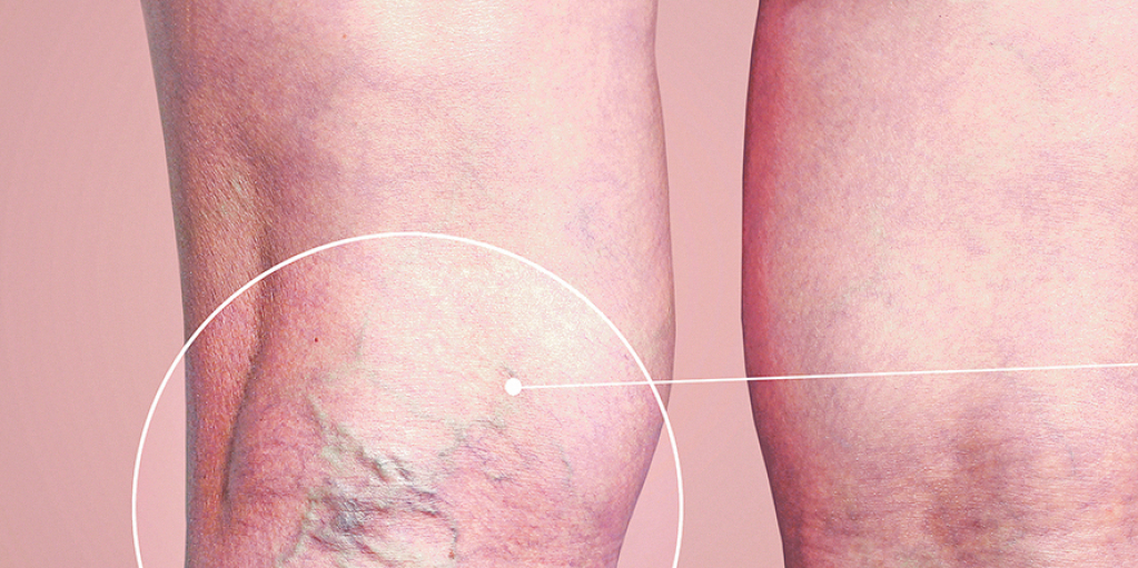 RANE NA VENAMA Adekvatni melemi i masti mogu da poboljšaju stanje oštećene kože na nogama